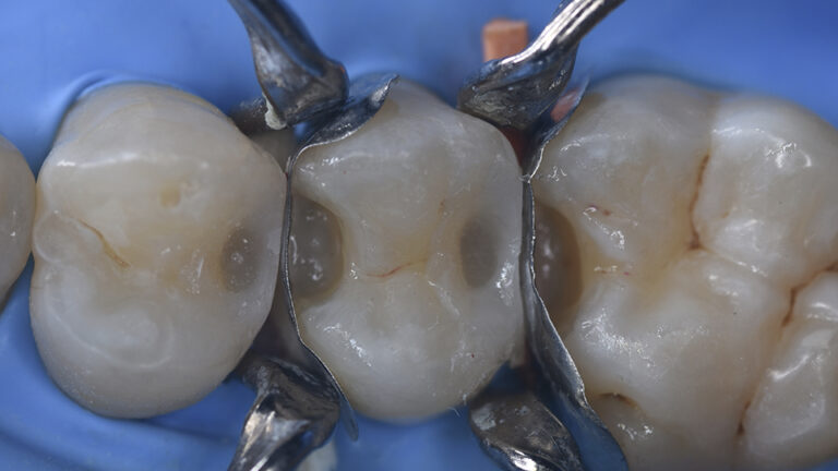 G-ænial Universal Injectable – campaigns-gceurope